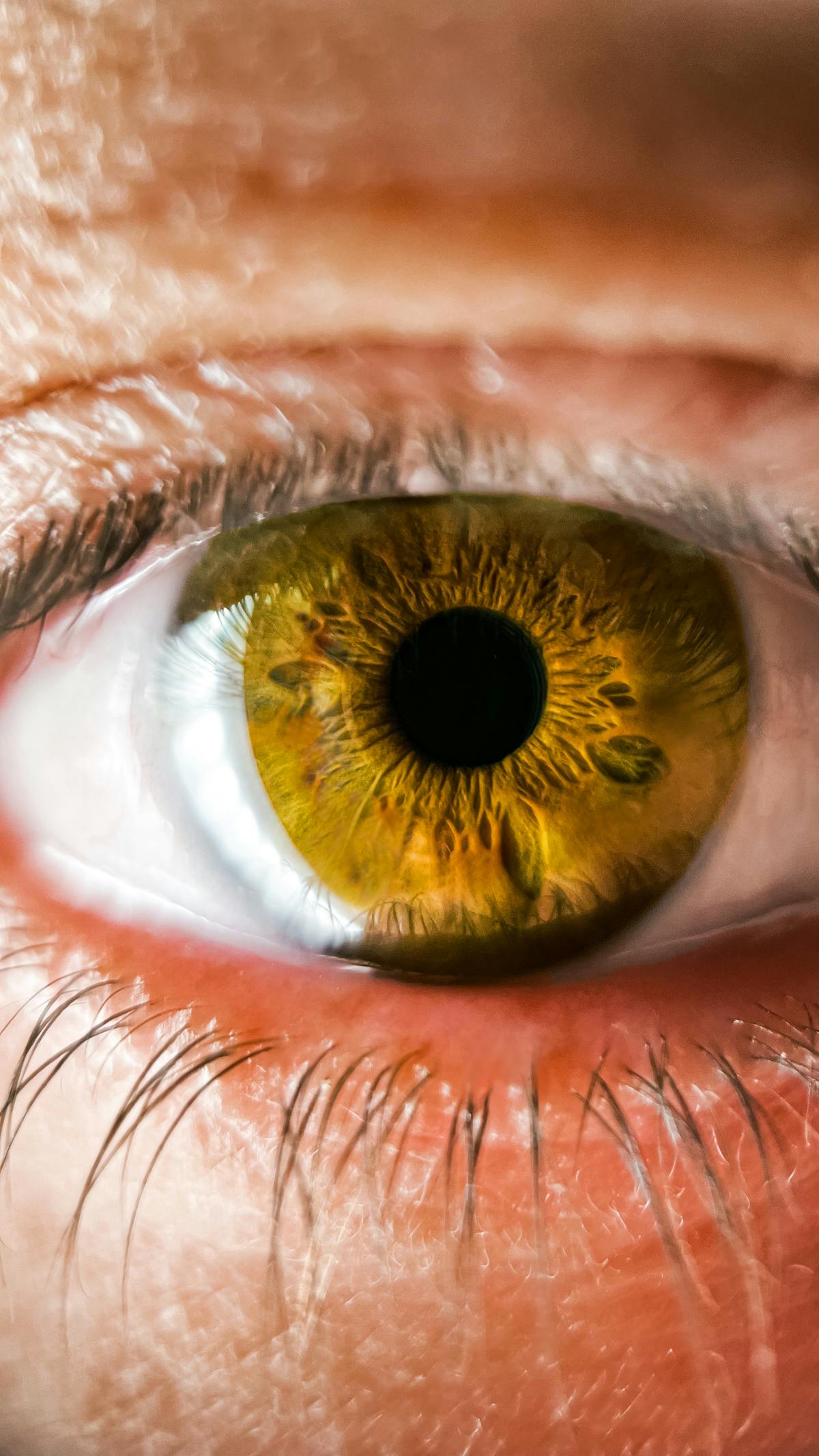 Eye showing the redness typical of conjunctivitis.