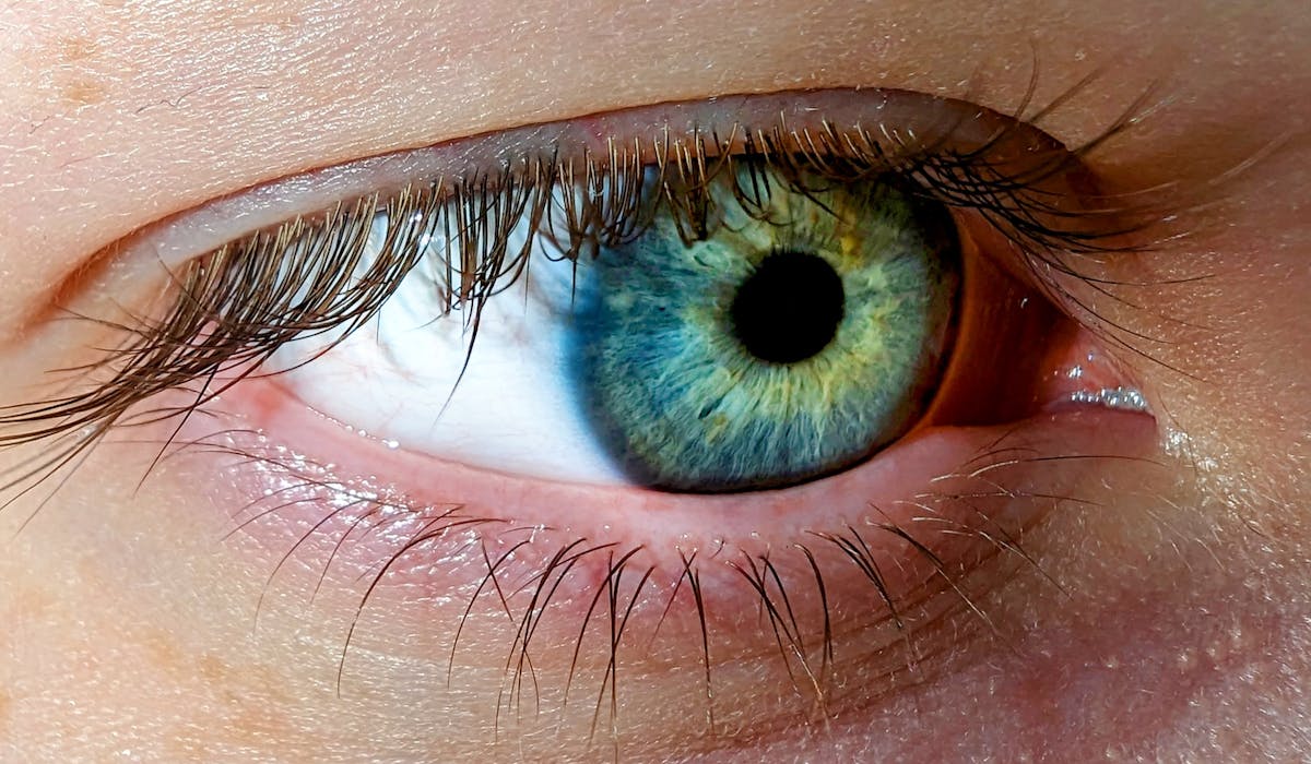 Diyabetik Retinopati