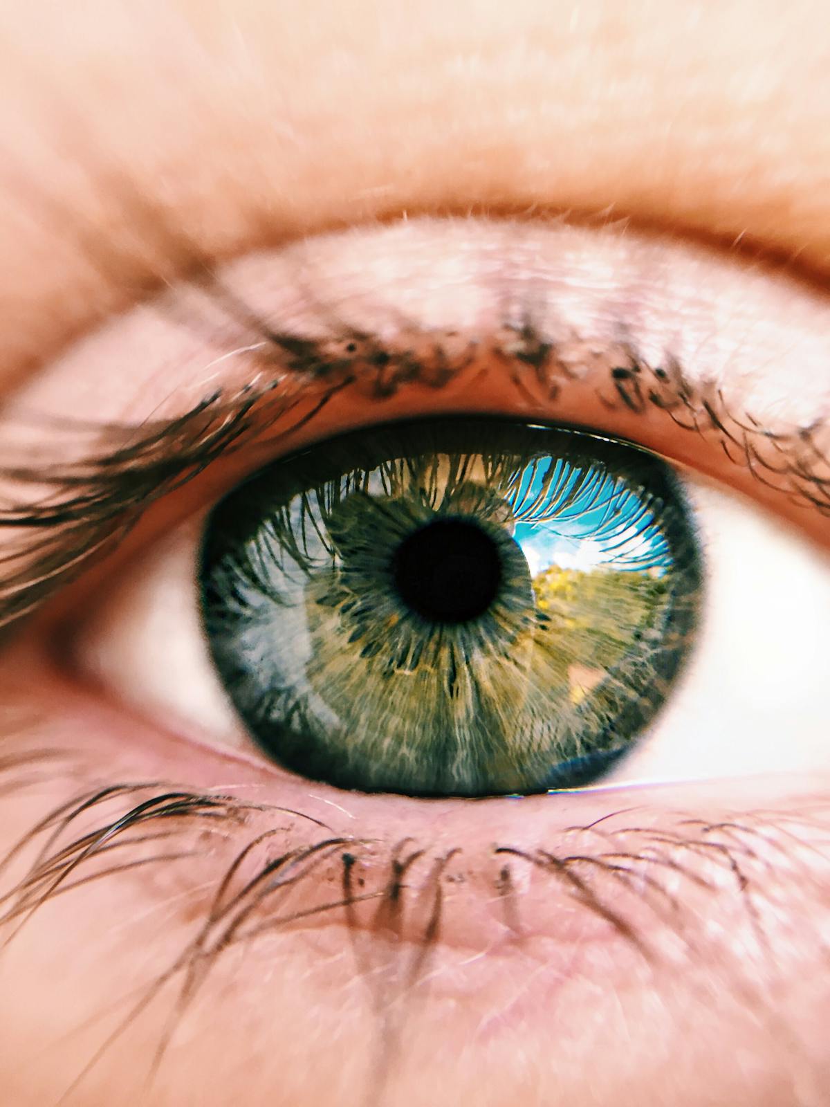 Close-up of an irritated eye showing dry-eye surface changes.