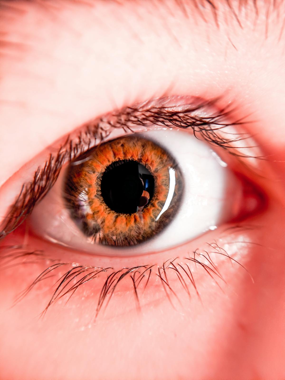 Child with eyes pointing in slightly different directions, characteristic of strabismus.